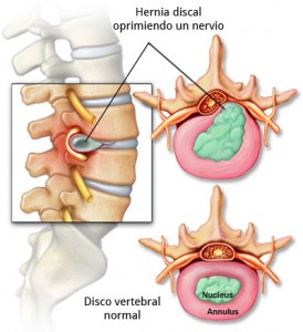 hernia-discal Hernia-discal-fisioterapia-zaragoza