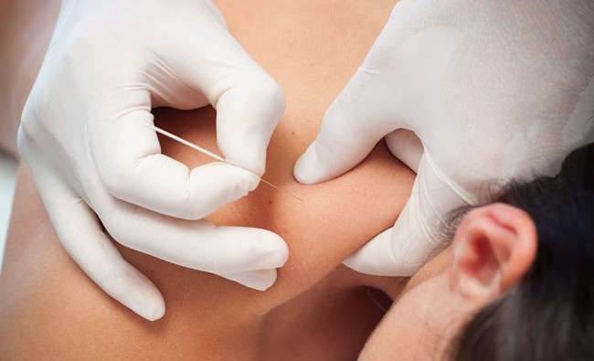 fisioterapia-punción-seca